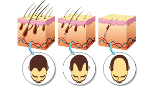 معرفی آزمایش‌های مربوط به ریزش مو
